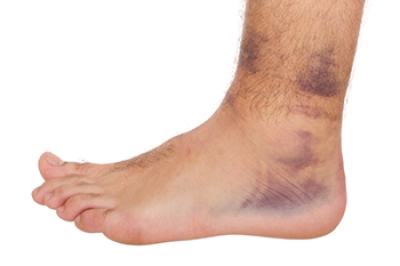 Ankle Sprains and Strains